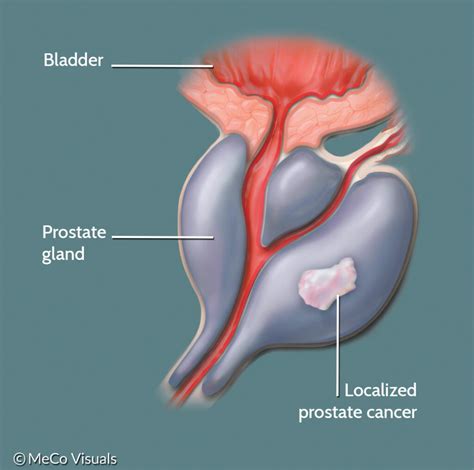 What Are The Symptoms Of Advanced Prostate Cancer / Prostate Cancer ...