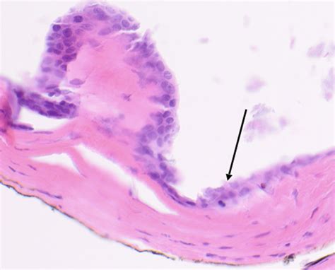 Apocrine Hidrocystoma Eyewiki