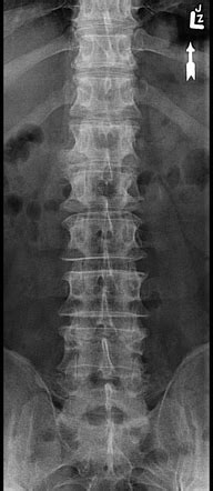 Six lumbar type vertebrae | Radiology Case | Radiopaedia.org