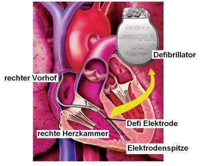 Herzchirurgie Herzschrittmacher Und Defibrillatoren