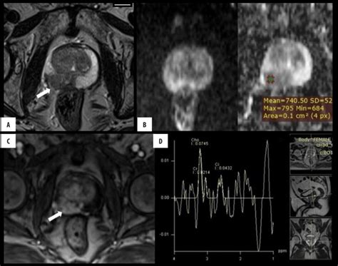 Role Of Magnetic Resonance Imaging Magnetic Resonance Spectroscopy And Transrectal Ultrasound