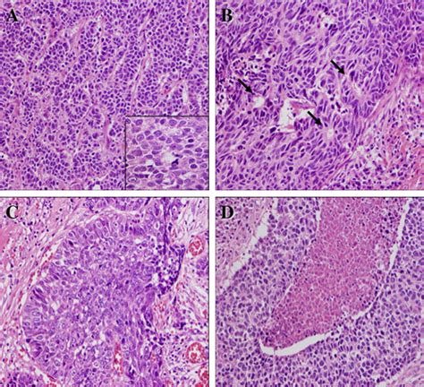 Mucosal Large Cell Neuroendocrine Carcinoma Of The Head And Neck