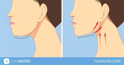 3 Formas De Acabar Com A Papada Do Pescoço Tua Saúde