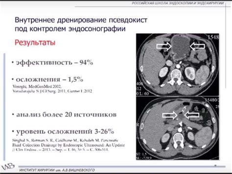 Хирургические аспекты лечения острого панкреатита - презентация онлайн