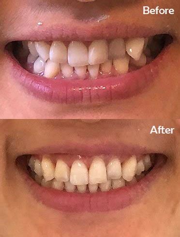 Invisalign Braces Before And After