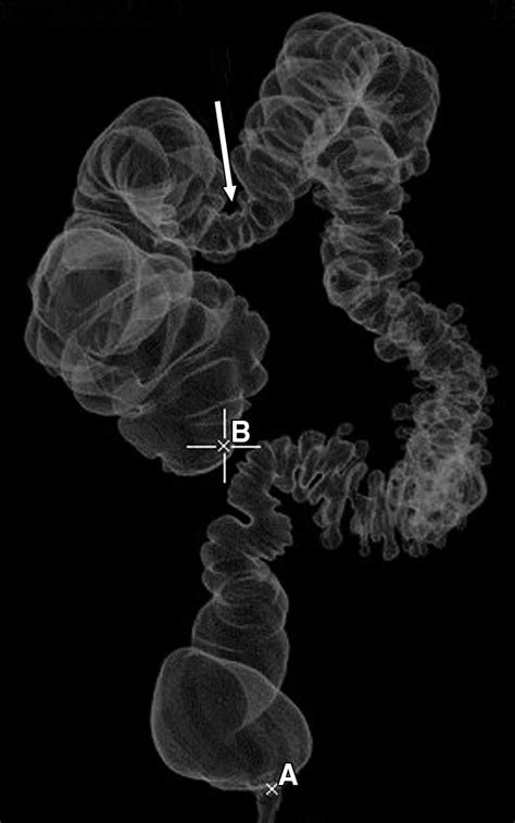 CT Colonography For Incomplete Or Contraindicated Optical Colonoscopy