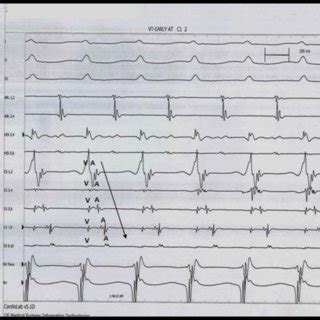 Intracardiac tracing during AVRT with three surface ECG leads and EGMs... | Download Scientific ...