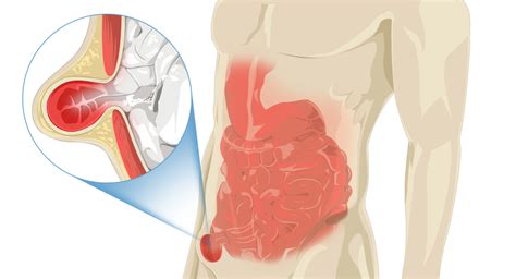 Hernia inguinal y hernias de pared abdominal Dr Víctor Guibovich Sparrow