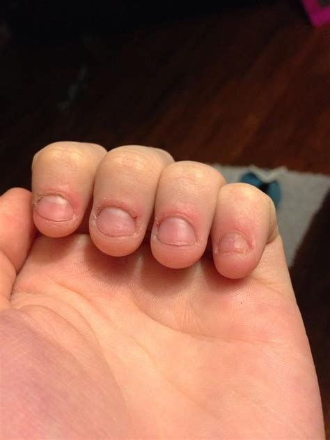 Severely Bitten Nails