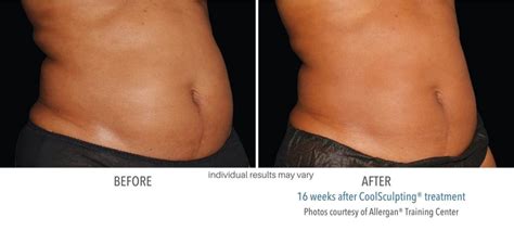 CoolSculpting Before and After Findings of Actual Patients