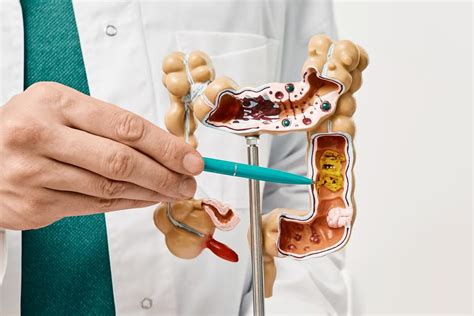 Understanding The Importance Of Colonoscopy In Preventing Colorectal