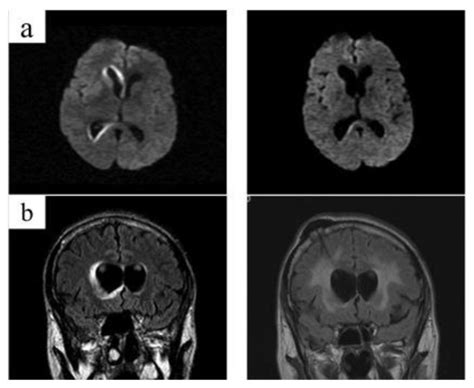 Cranial Magnetic Resonance Imaging Mri Findings Prior To Left Download Scientific Diagram