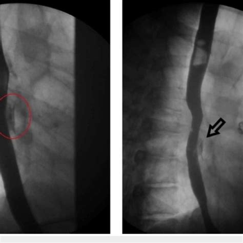 Upper Gi Series Demonstrating Esophageal Tear With Extravasation Of