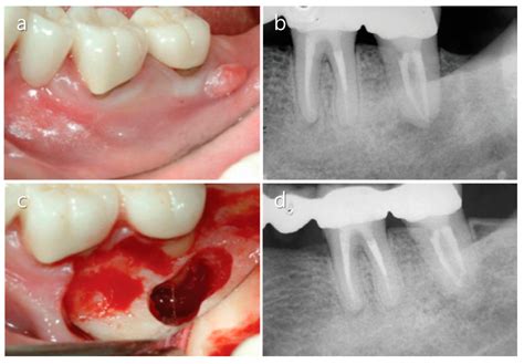 An Update On Endodontic Microsurgery Of Mandibular Molars A Focused Review