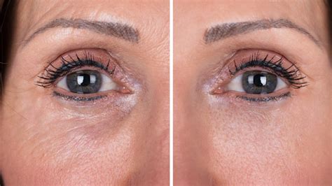 Elimina Las Ojeras Y Rejuvenece Tu Contorno De Ojos Sin Maquillaje