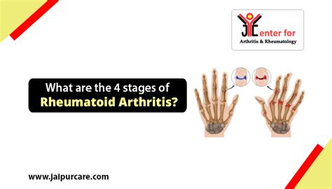 What are the 4 stages of Rheumatoid Arthritis? | JaipurCare