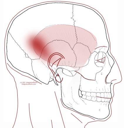 Headache Above/ Behind Ear Wearing Hat - Integrative Works