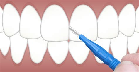 How To Choose The Best Interdental Brush? - Dental Care Club