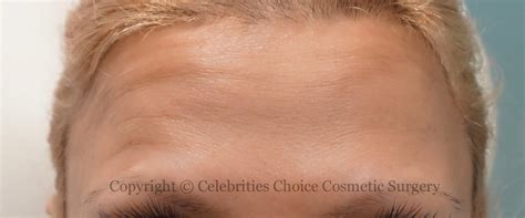 Botox Forehead - Celebrities Choice Cosmetic Surgery - Dr. Trevisani