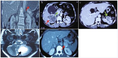 typical clinical imaging data   patients affected  vhl