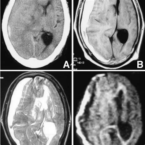 Case 1 A Computed Tomography Scan Showing The Subdural Hematoma As