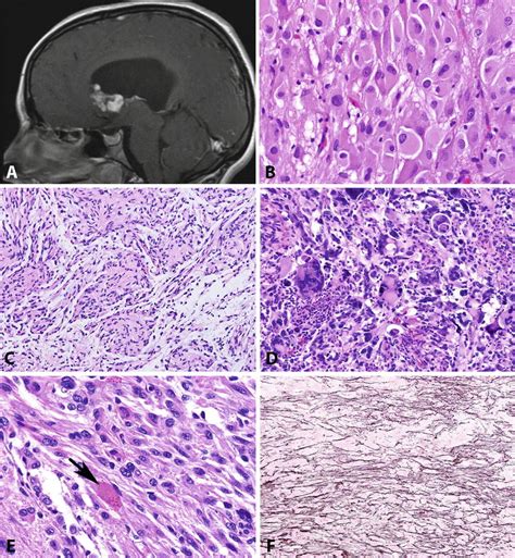 Low Grade Gliomas Basicmedical Key