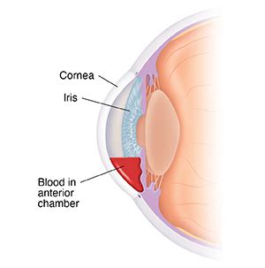 Bleeding In The Front Of The Eye Hyphema Saint Luke S Health System