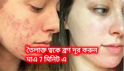 তৈলাক্ত ত্বকে ব্রণ দূর করার উপায়