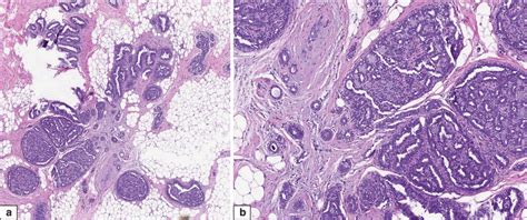 Benign Sclerosing Lesions Basicmedical Key