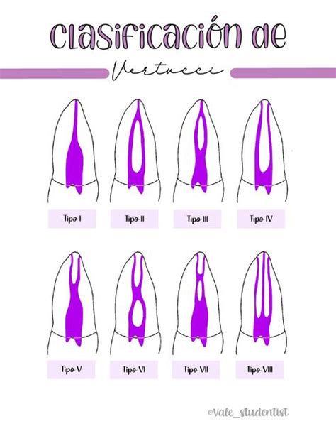 Clasificaci N De Vertucci Vale Dentist Udocz