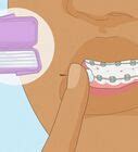 How To Apply Dental Wax On Braces Steps With Pictures