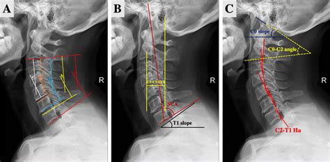 Radiographic Evaluation Of Sagittal Alignment Of Cervical Spine Aa Download Scientific Diagram