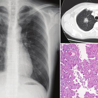 Pathological Findings Of Sclerosing Hemangioma A Sclerosing