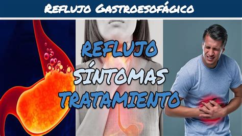 REFLUJO GASTRICO Y ESOFÁGICO Causas Síntomas y Tratamiento YouTube