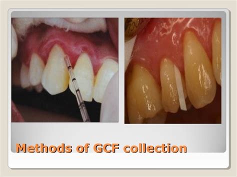 Defence Mechanism Of Gingivae