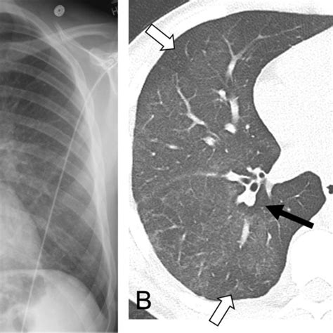 Pediatric Electronic Cigarette Or Vaping Product Useassociated Lung