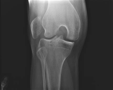 Lateral Patellar Dislocation Image Radiopaedia Org