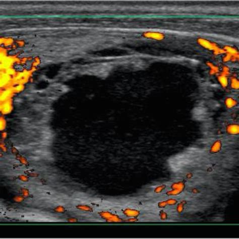 Ultrasound Examination Of The Thyroid Gland On Admission Day 4 Showing Download Scientific