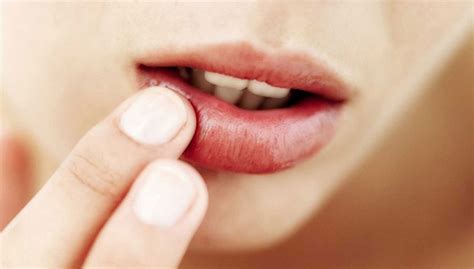 ¿por Qué Se Producen Llagas En La Boca Clínica Dental Alberto Barreiro