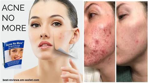 Acne No More Review Acne Removal Youtube