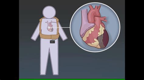 Tragbarer Kardioverter Defibrillator Vest Studie Youtube