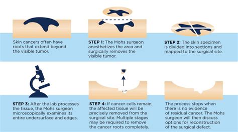 About MOHS Surgery - Skin Surgery Center of Oklahoma