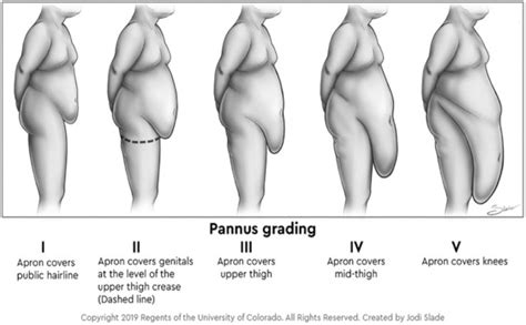 Excess Skin Problems Among Adolescents After Bariatric Surgery