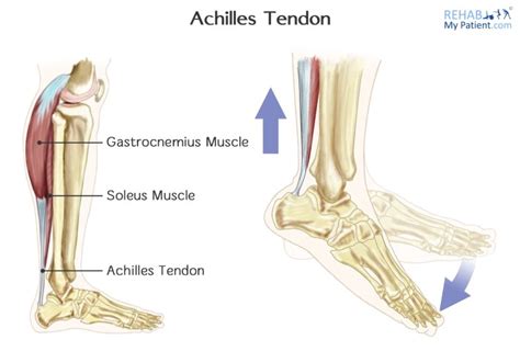 Achilles Tendinopathy Rehab My Patient