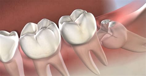 How Medicare Works with Wisdom Teeth Removal | Sydney CBD Dentistry