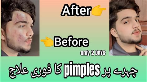 Pimples Ka Ilaaj Sirf 2 Din K Andr Andr Foryou Acne Face Viral