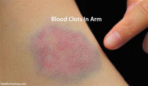 Blood Clot in Arm Symptoms, Causes, Diagnosis, Treatment