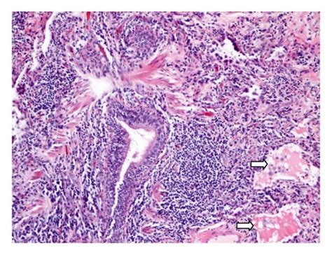 Photomicrographs Of Lung Biopsy With Hematoxylin Eosin Stain A 100x