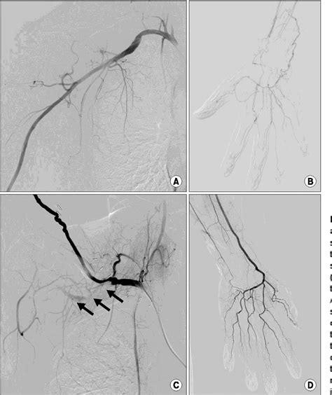 Figure 2 from Bypass Surgery in Arterial Thoracic Outlet Syndrome ...