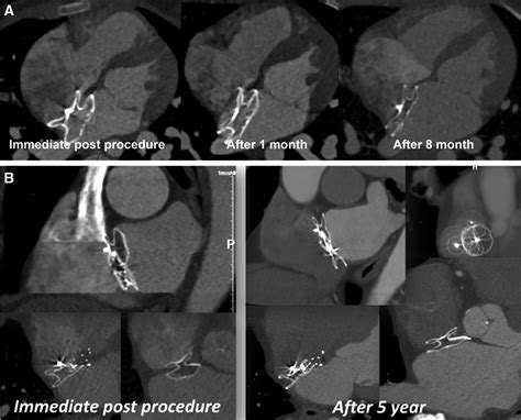 Assessment Of Device Neoendothelialization With Cardiac Computed